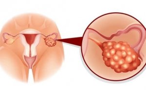 Menstruasiya gecikmələri polikistik yumurtalıq riskini artırır? Video/