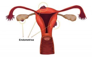 Endometrioz - yenidən qayıda bilər? video/