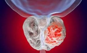 Prostat vəzi xəstəlikləri – kişilərdə səssizcə inkişaf edən təhlükə! video/