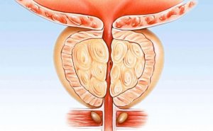 Sidikdə yanma, ağrı, narahatlıq – prostat xəbərdarlığı ola bilər? video/