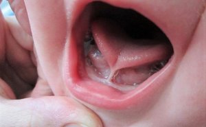 Uşaqlarda Dil Altı Yapışıqlıq (Dil Bağı) – Valideynlər Bunu Mütləq Bilməlidir! video/