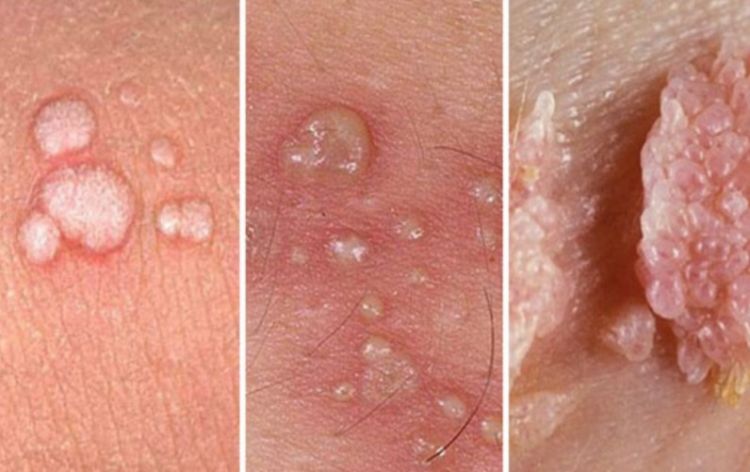 Bu virusdan xəbərdar olun: HPV nədir və necə yayılır? video/